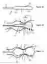 Fig. 02 - Positionable valvuloplasty catheter