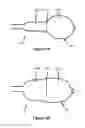 Fig. 03 - Positionable valvuloplasty catheter