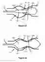 Fig. 04 - Positionable valvuloplasty catheter
