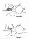 Fig. 05 - Positionable valvuloplasty catheter