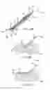 Fig. 83 - Method for vessel access closure