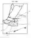 Fig. 35 - Mechanical method and apparatus for sequential tissue fastening