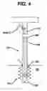 Fig. 04 - SUTURE ANCHOR WITH ENHANCED FIXATION