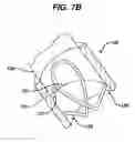 Fig. 08 - SUTURE ANCHOR WITH ENHANCED FIXATION