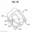Fig. 08 - SUTURE ANCHOR WITH SUTURE MANAGEMENT