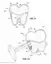 Fig. 06 - Inter-vertebral support kit including main insert jack and dual secondary auxiliary support jacks located between succeeding transverse processes