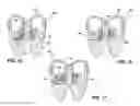 Fig. 08 - Inter-vertebral support kit including main insert jack and dual secondary auxiliary support jacks located between succeeding transverse processes
