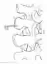 Fig. 06 - Implanting facet joint screws percutaneously