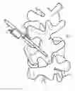 Fig. 08 - Implanting facet joint screws percutaneously