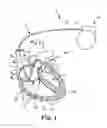 Fig. 02 - Medical device lead including a rotatable composite conductor