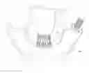 Fig. 01 - Device for collapsing and loading a heart valve into a minimally invasive delivery system