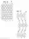 Fig. 09 - Expandable sheath for introducing an endovascular delivery device into a body