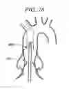Fig. 35 - Prosthetic valve for transluminal delivery