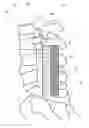 Fig. 01 - SPINAL IMPLANT STRUCTURE AND METHOD FOR MANUFACTURING THE SAME