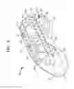 Fig. 03 - Method of inserting surgical implant with guiding rail
