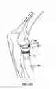 Fig. 07 - Modular radial head prostheses