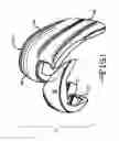 Fig. 02 - Knee arthroplasty prosthesis