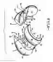 Fig. 06 - Knee arthroplasty prosthesis