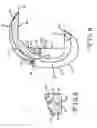Fig. 08 - Knee arthroplasty prosthesis