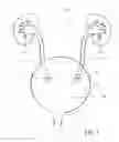 Fig. 02 - Ureteral stent