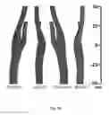 Fig. 18 - Model-based systems and methods for analyzing and predicting outcomes of vascular interventions and reconstructions
