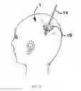 Fig. 06 - Methods for distributing agents to areas of brain