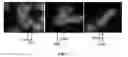 Fig. 04 - Characterization of chromosomal inversions using anti-parallel probes