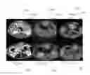 Fig. 01 - METHODS AND APPARATUS TO DELIVER NANOPARTICLES TO TISSUE USING
ELECTRONANOTHERAPY