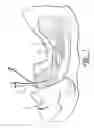 Fig. 02 - PARAMETER-SENSING ENDOTRACHEAL TUBE