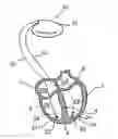 Fig. 01 - Implantable cardiac stimulator, system, device and method for monitoring cardiac synchrony
