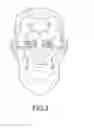 Fig. 03 - Implant device, tool, and methods relating to treatment of paranasal sinuses