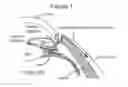 Fig. 02 - Subconjunctival conformer device and uses thereof