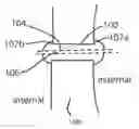 Fig. 01 - Glaucoma drainage device and uses thereof