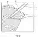 Fig. 54 - Method for providing surgical access