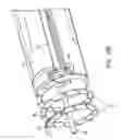 Fig. 61 - Method for providing surgical access