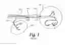Fig. 02 - Microvalve protection device and method of use for protection against embolization agent reflux