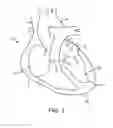 Fig. 02 - SYSTEM FOR TENSIONING A SURGICAL CLOSURE