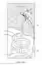 Fig. 49 - SYSTEM FOR TENSIONING A SURGICAL CLOSURE