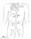 Fig. 02 - PARTIAL AORTIC OCCLUSION DEVICES AND METHODS FOR CEREBRAL PERFUSION AUGMENTATION