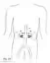 Fig. 35 - PARTIAL AORTIC OCCLUSION DEVICES AND METHODS FOR CEREBRAL PERFUSION AUGMENTATION