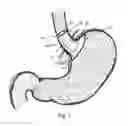 Fig. 02 - Bariatric device and method