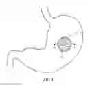 Fig. 02 - Temporary gastric device (TGD) and method of use
