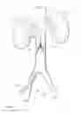 Fig. 02 - FILTER WITH MAGNETIC TIP FOR CLOT FRAGMENTATION