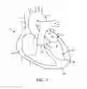 Fig. 02 - Method for providing surgical access