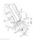 Fig. 72 - Method for providing surgical access