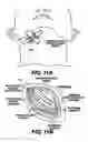 Fig. 09 - Obstructive sleep apnea treatment devices, systems and methods