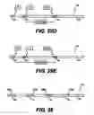 Fig. 32 - Obstructive sleep apnea treatment devices, systems and methods