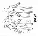 Fig. 40 - Obstructive sleep apnea treatment devices, systems and methods