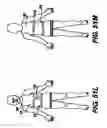 Fig. 49 - Obstructive sleep apnea treatment devices, systems and methods
