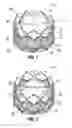 Fig. 02 - Spiraled commissure attachment for prosthetic valve